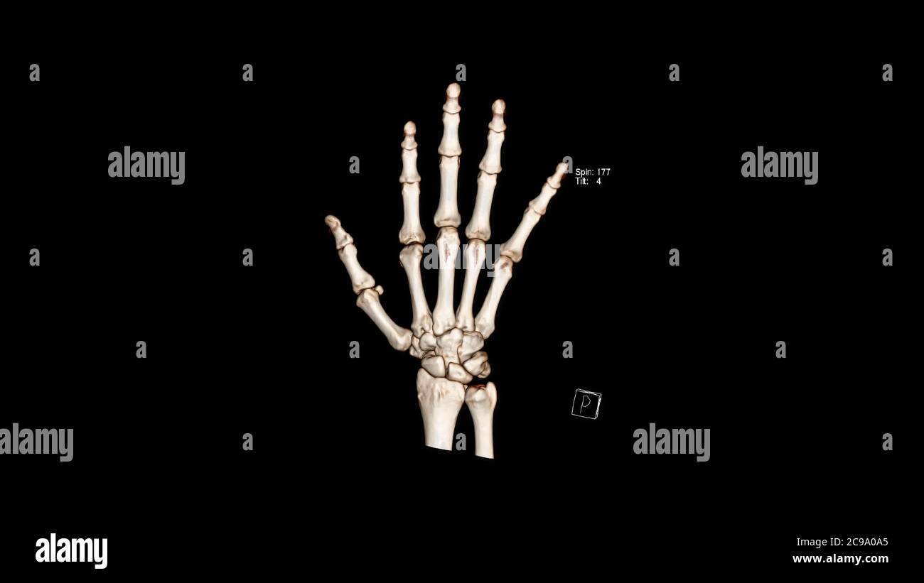 Tomodensitométrie Volume Rendering examen de la main montrant l'anatomie normale (CT VR Hand). Rendu 3D Banque D'Images