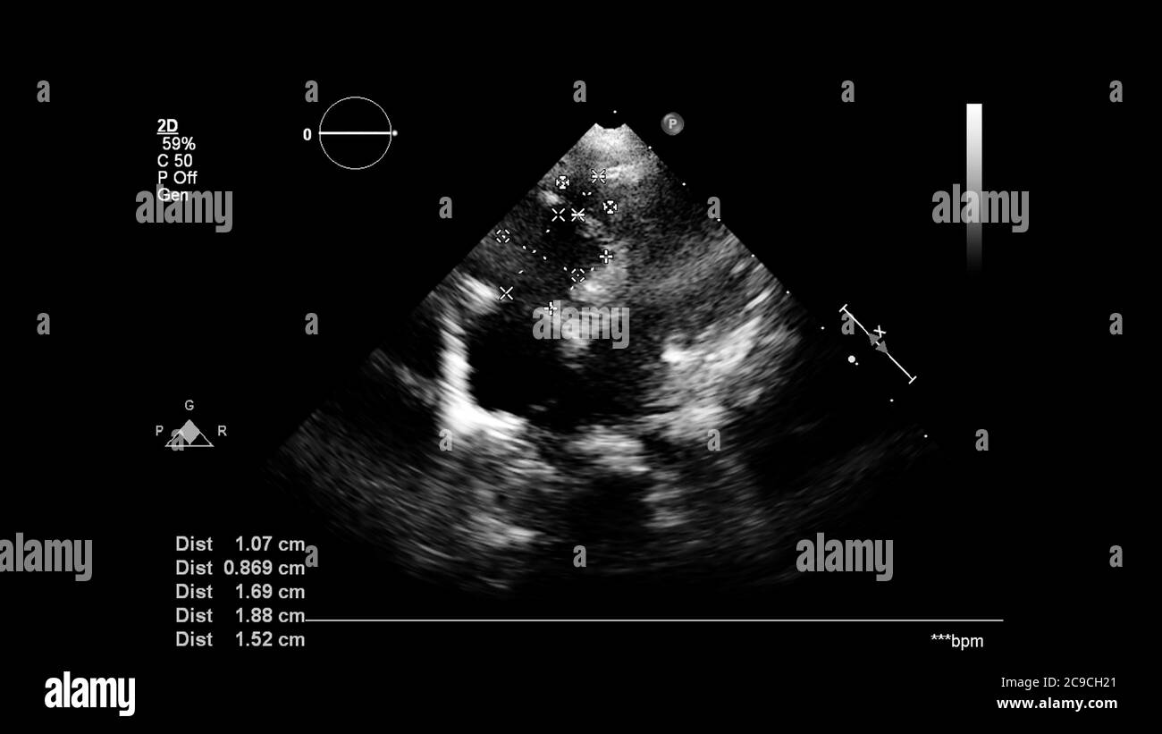 Image du cœur en mode échelle de gris pendant l'échographie transœsophagienne. Banque D'Images