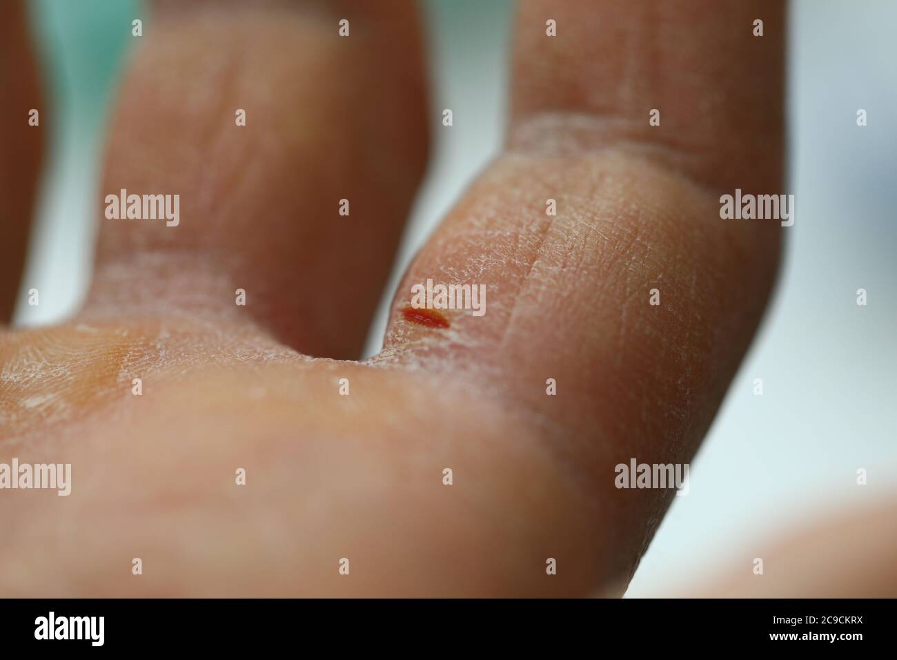 Peau qui pèle Banque de photographies et d’images à haute résolution Alamy