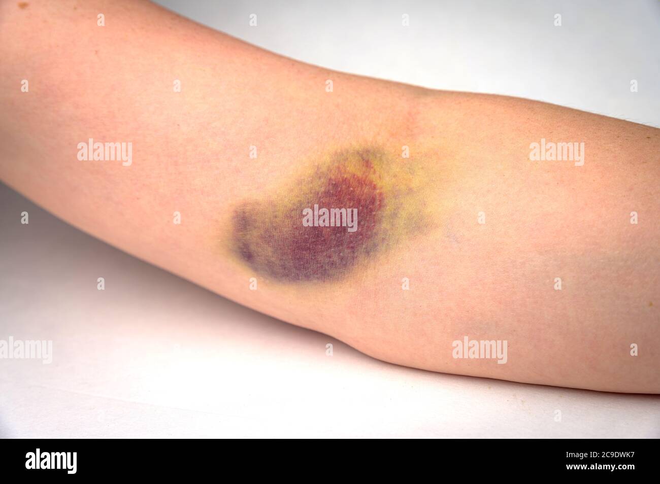 Gros plan d'une très grande ecchymose sur un bras humain après un  prélèvement de sang bâché Photo Stock - Alamy