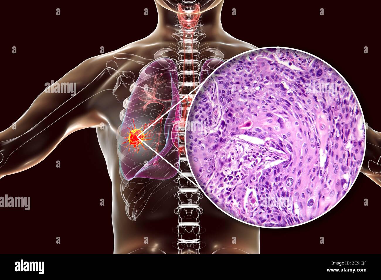 Illustration informatique et micrographe léger du carcinome épidermoïde du poumon. Banque D'Images