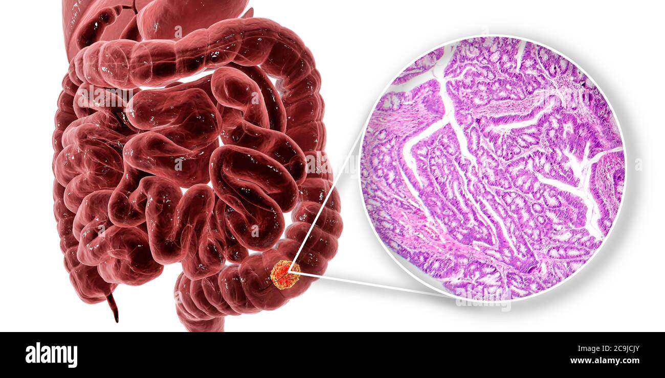 Cancer du côlon, illustration informatique et micrographe lumineux montrant l'adénocarcinome du côlon. Banque D'Images