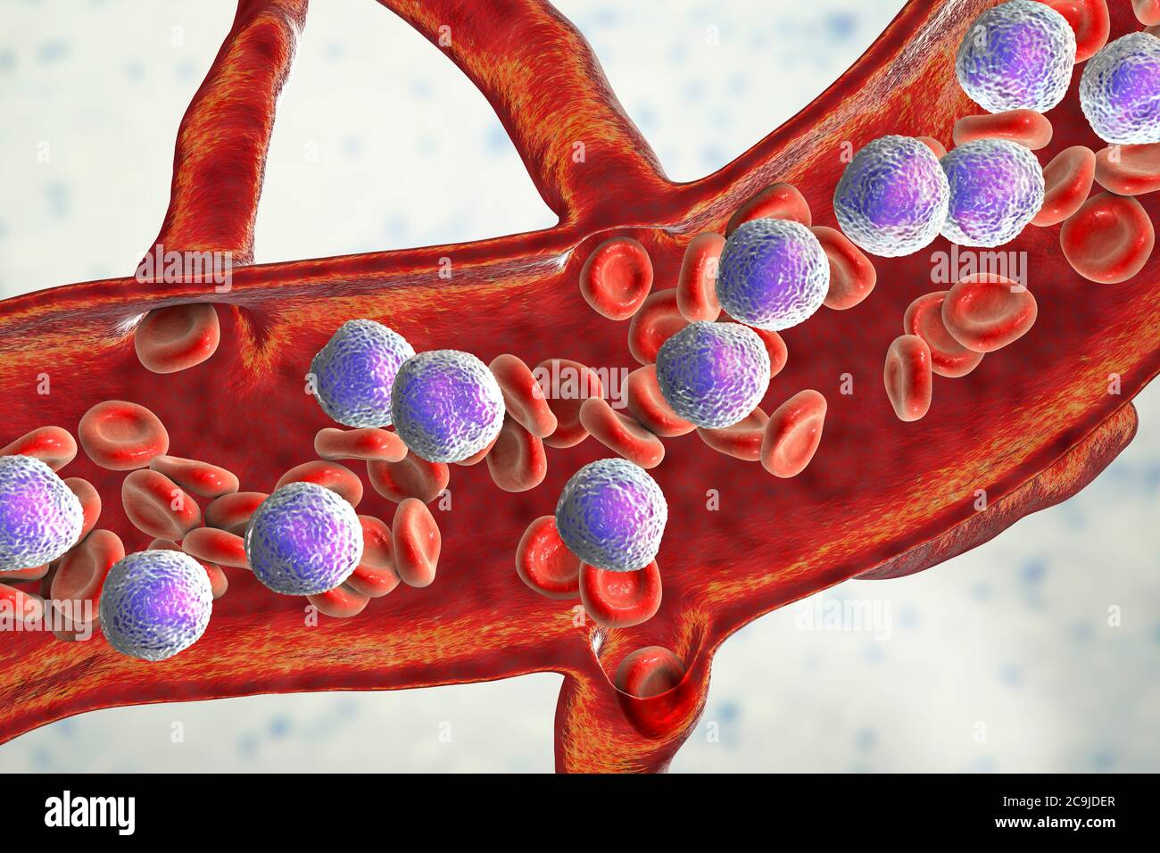 Illustration informatique d'une coupe transversale de vaisseau sanguin d'un patient atteint de leucémie lymphoblastique aiguë (TOUS) montrant des lymphoblastes abondants (violet Banque D'Images