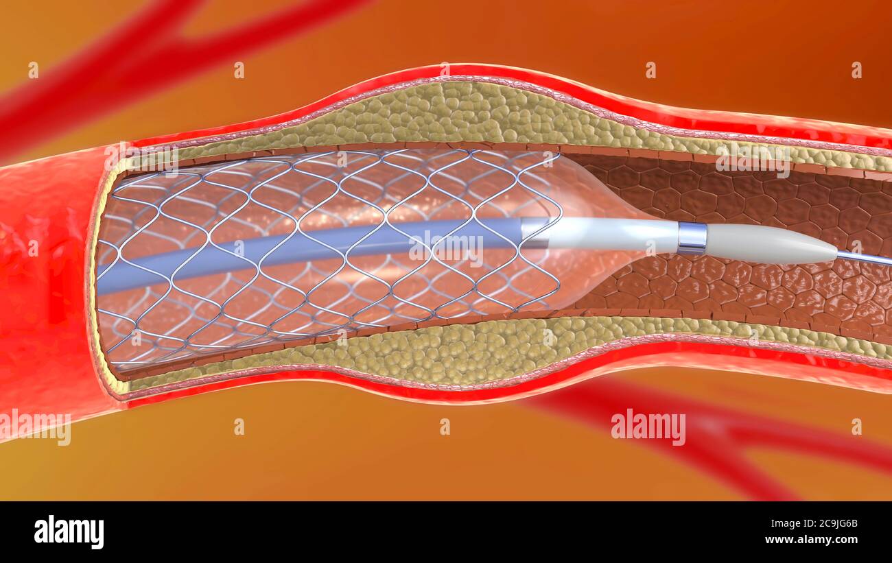 Stent artériel, illustration. Banque D'Images