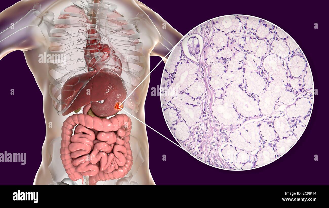Adénocarcinome mucineux de l'estomac humain, illustration informatique et micrographe léger. Banque D'Images