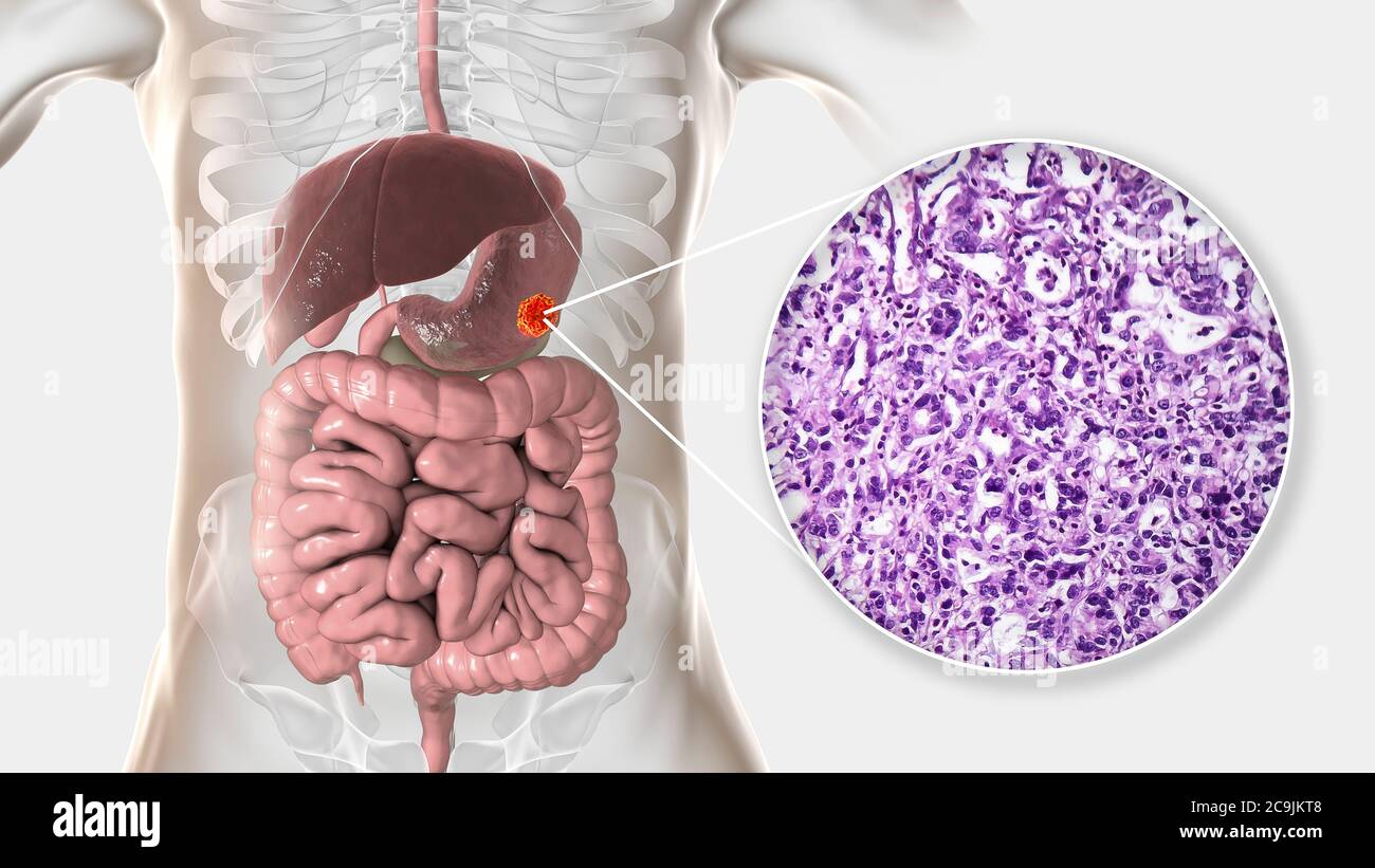Adénocarcinome de l'estomac humain, illustration informatique et micrographe léger. Banque D'Images