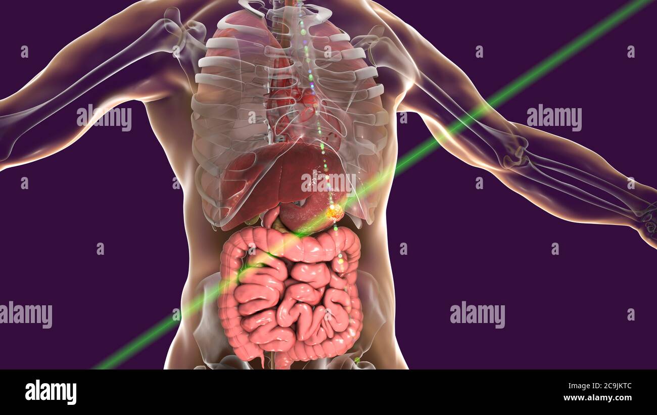 Traitement du cancer de l'estomac humain, ordinateur conceptuel illustration. Banque D'Images