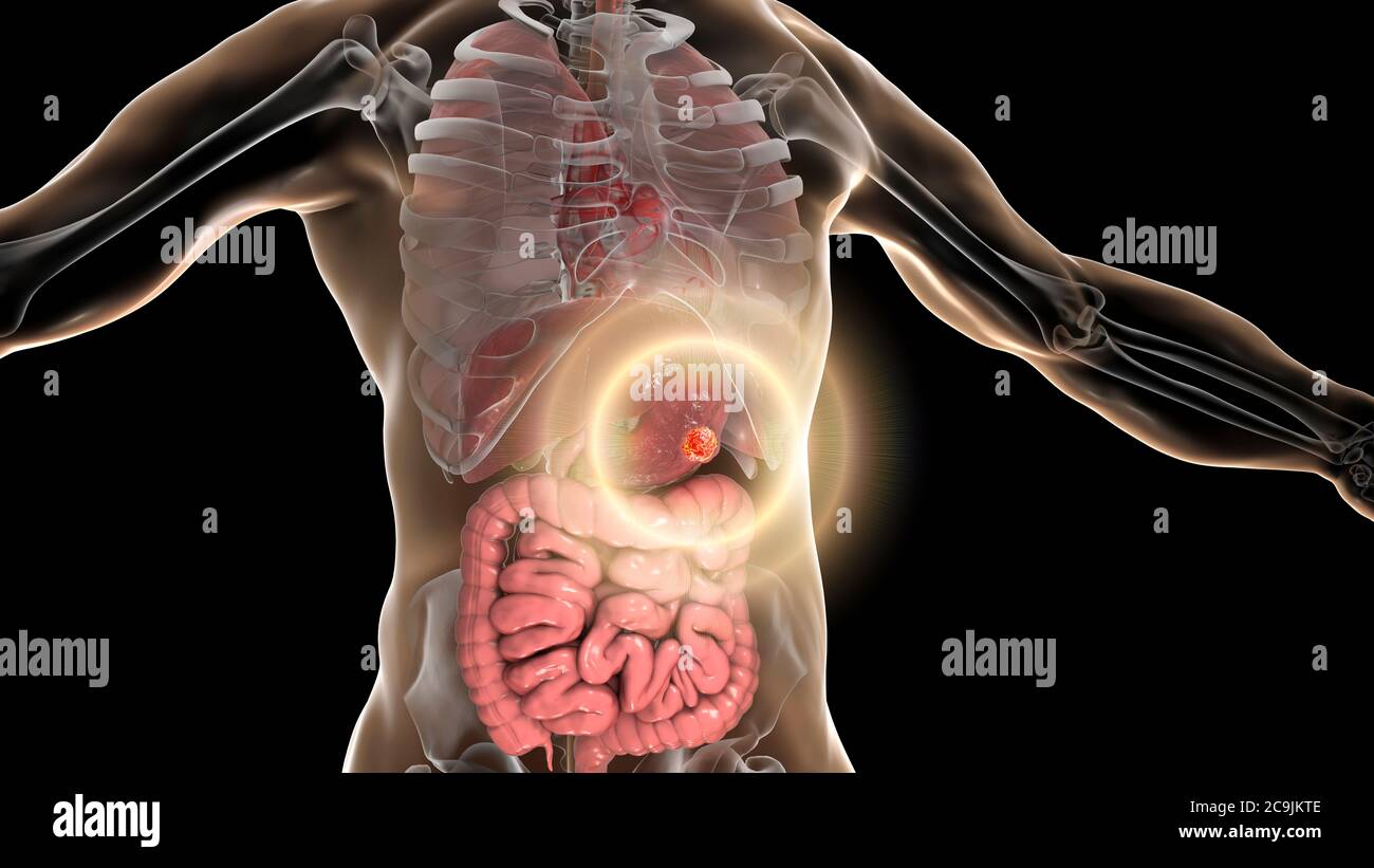 Traitement du cancer de l'estomac humain, ordinateur conceptuel illustration. Banque D'Images