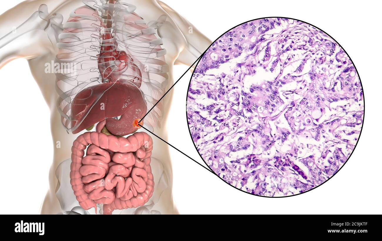 Adénocarcinome mucineux de l'estomac humain, illustration informatique et micrographe léger. Banque D'Images