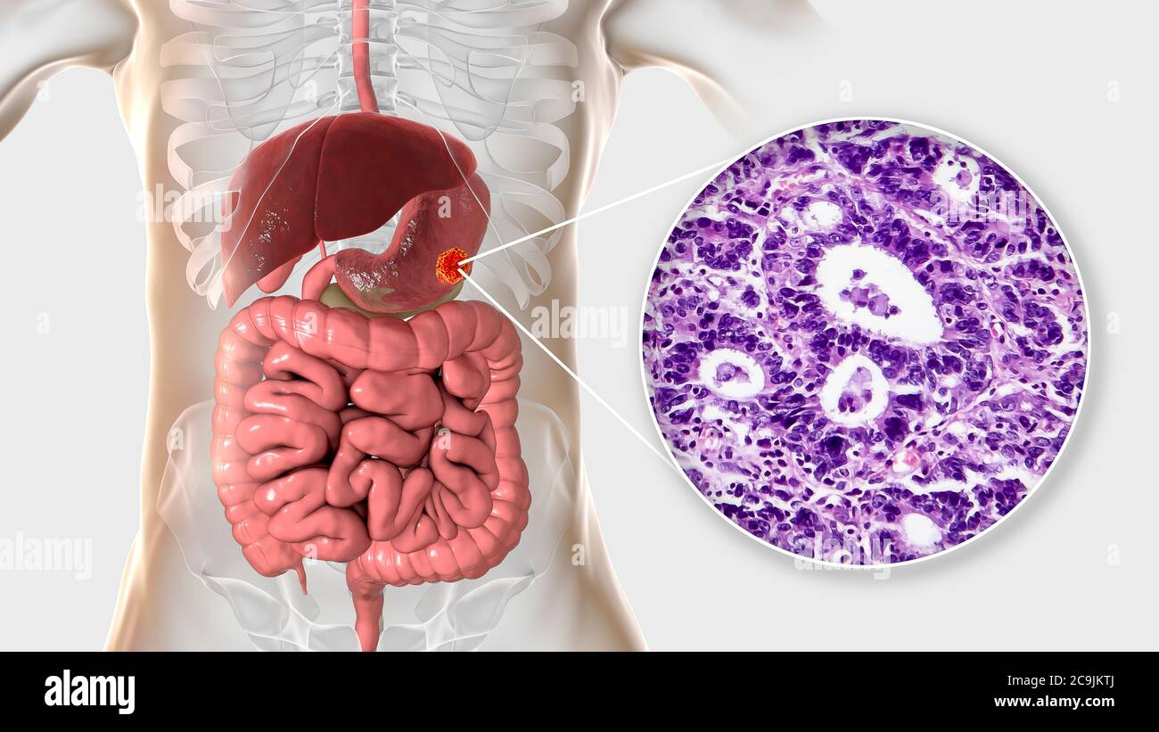 Adénocarcinome de l'estomac humain, illustration informatique et micrographe léger. Banque D'Images