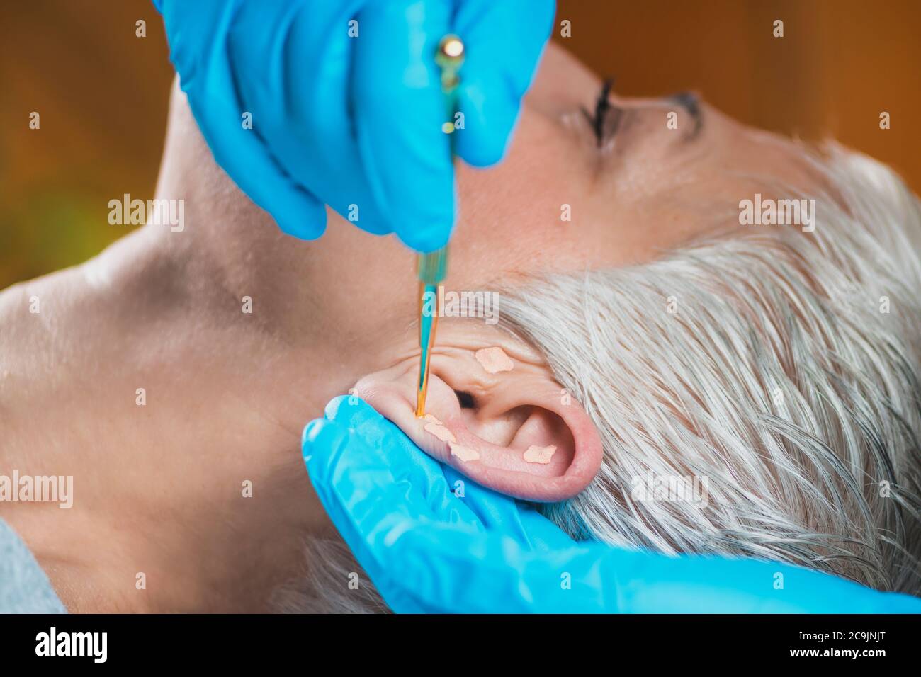 Auriculothérapie, ou traitement auriculaire sur l'oreille humaine, gros  plan. Main du thérapeute appliquant l'autocollant de la graine d'oreille d' acupuncture avec une pince à épiler Photo Stock - Alamy