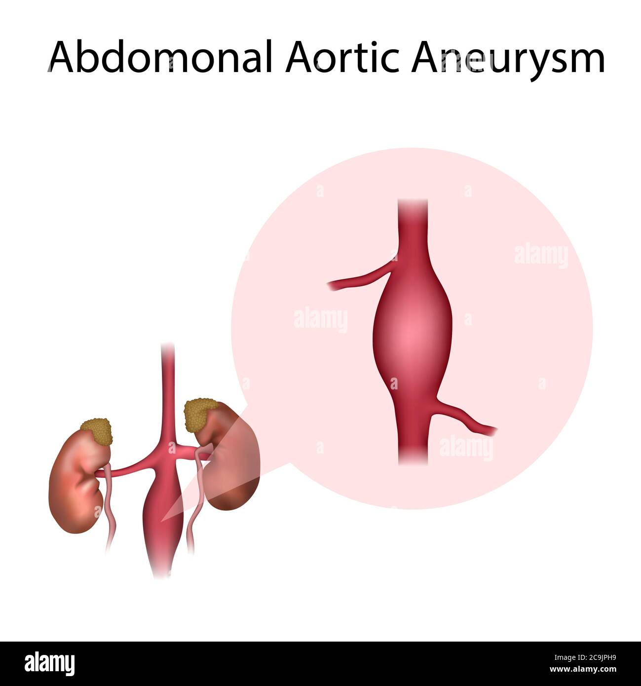 Anévrisme de l'aorte abdominale, illustration. Un anévrisme est une dilatation remplie de sang dans un vaisseau sanguin. Banque D'Images