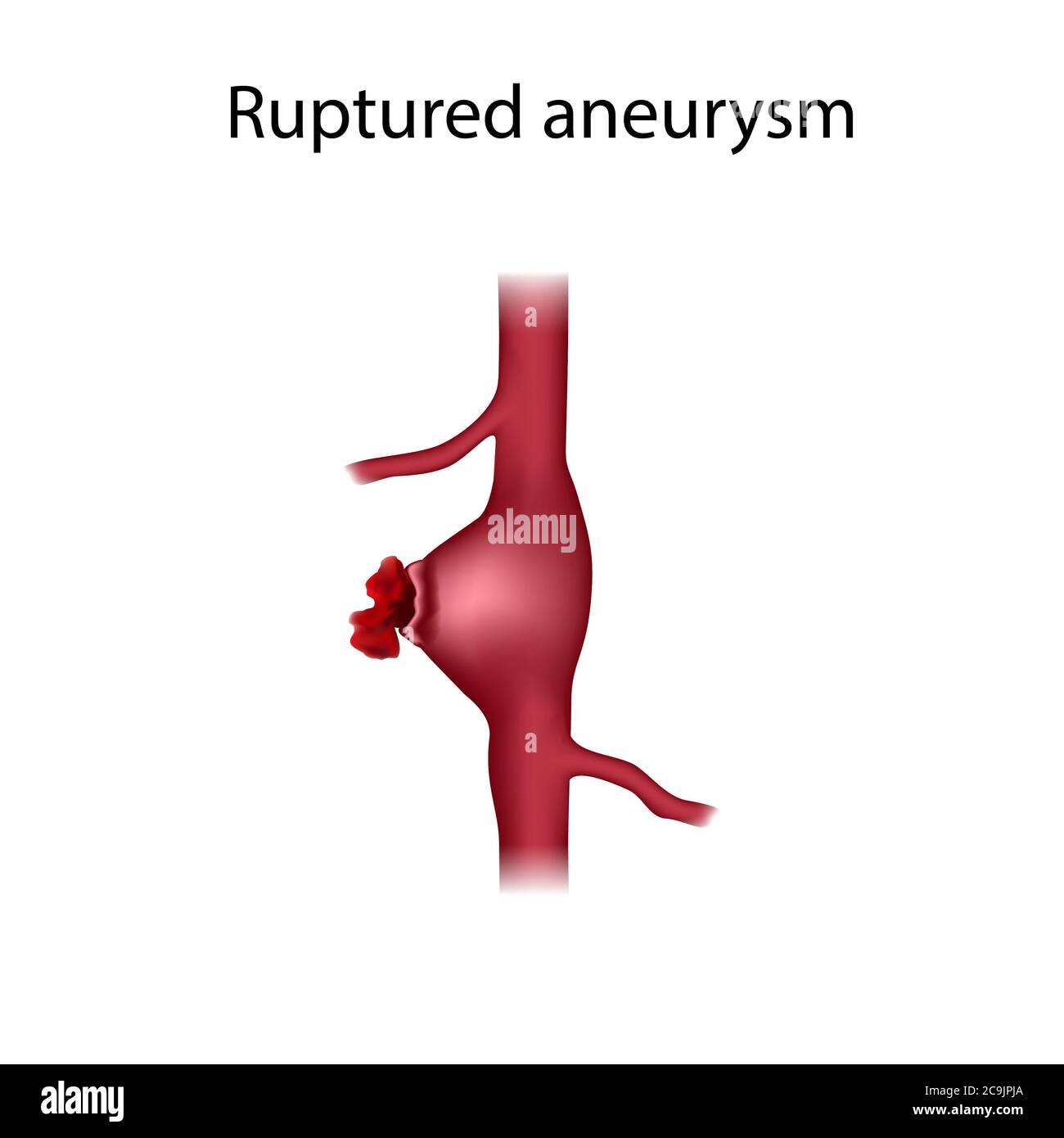 Rupture d'anévrisme, illustration. Un anévrisme est une dilatation remplie de sang dans un vaisseau sanguin. Banque D'Images