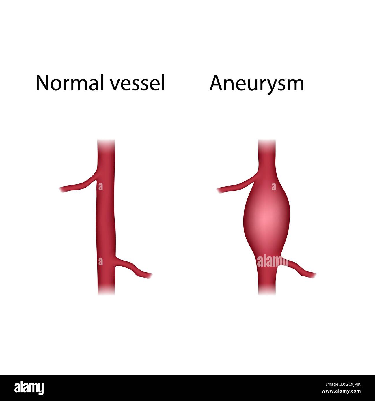 Comparaison des vaisseaux normaux et des anévrismes, illustration. Un anévrisme est une dilatation remplie de sang dans un vaisseau sanguin. Banque D'Images