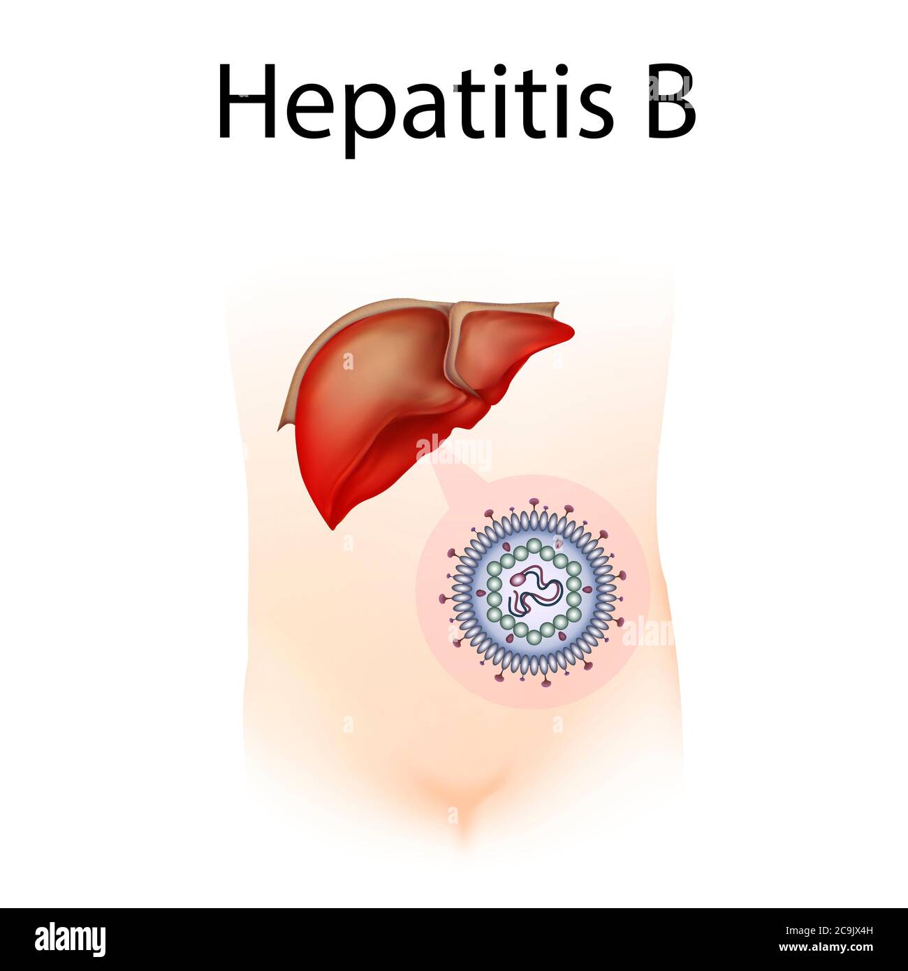 Hépatite B, illustration. L'hépatite est l'inflammation du foie. Banque D'Images