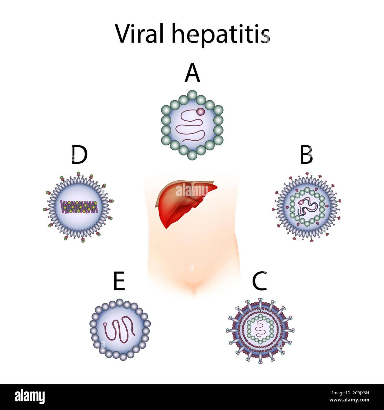 Types d'hépatite A B C D E, illustration. L'hépatite est l'inflammation du foie. Banque D'Images