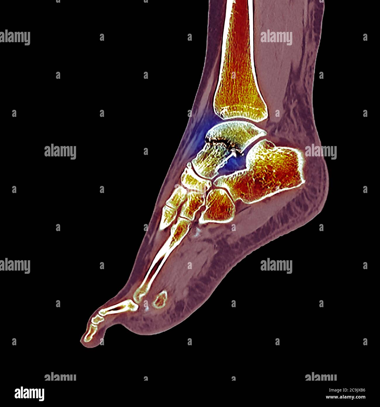 Fracture de l'os de la cheville. Tomodensitométrie colorée (CT) des os du pied et de la cheville d'une femme de 23 ans avec une comminée (fracturée) Banque D'Images
