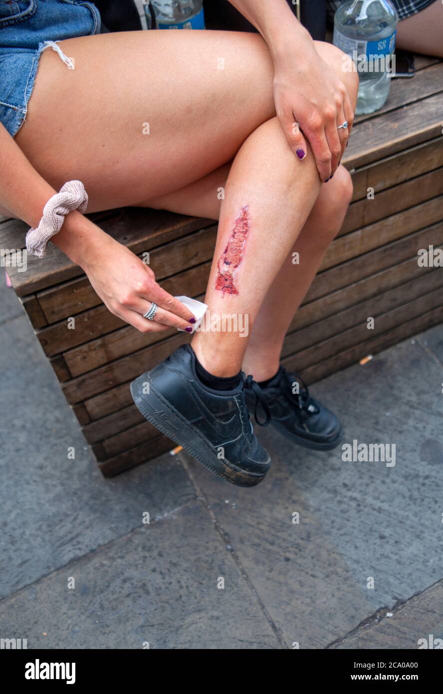 Une jeune femme s'occupe d'une grosse blessure à l'arrière de sa jambe, Londres, Angleterre, Royaume-Uni Banque D'Images