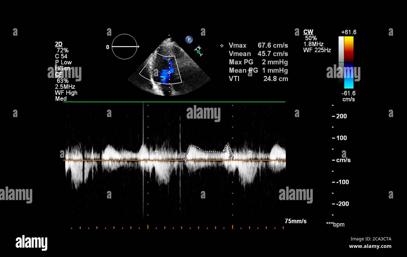 Image du cœur pendant l'échographie transœsophagienne avec mode Doppler. Banque D'Images