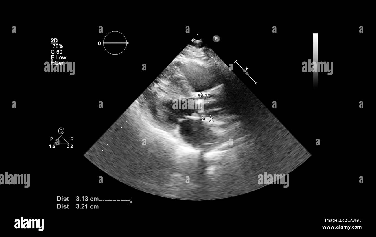 Image du cœur en mode échelle de gris pendant l'échographie transœsophagienne. Banque D'Images