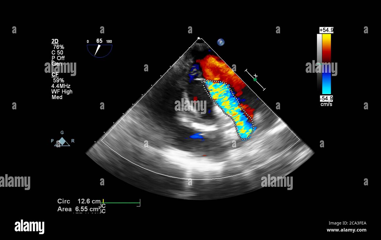 Image du cœur pendant l'échographie transœsophagienne avec mode Doppler. Banque D'Images
