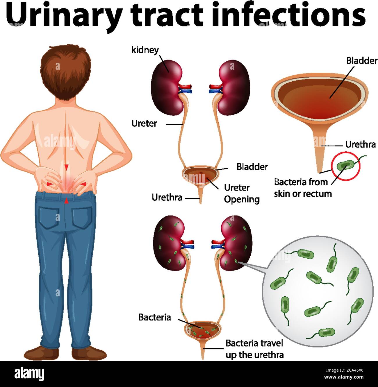 Illustration informative des infections des voies urinaires Illustration de Vecteur