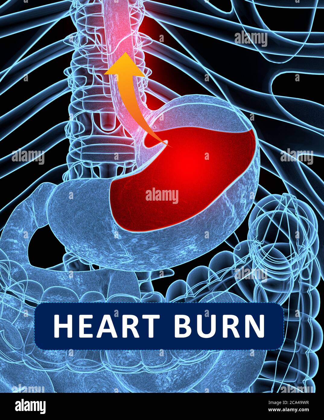 Reflux acide, GERD. Reflux gastro-oesophagien. Estomac et digestif. Anatomie humaine. illustration 3d Banque D'Images