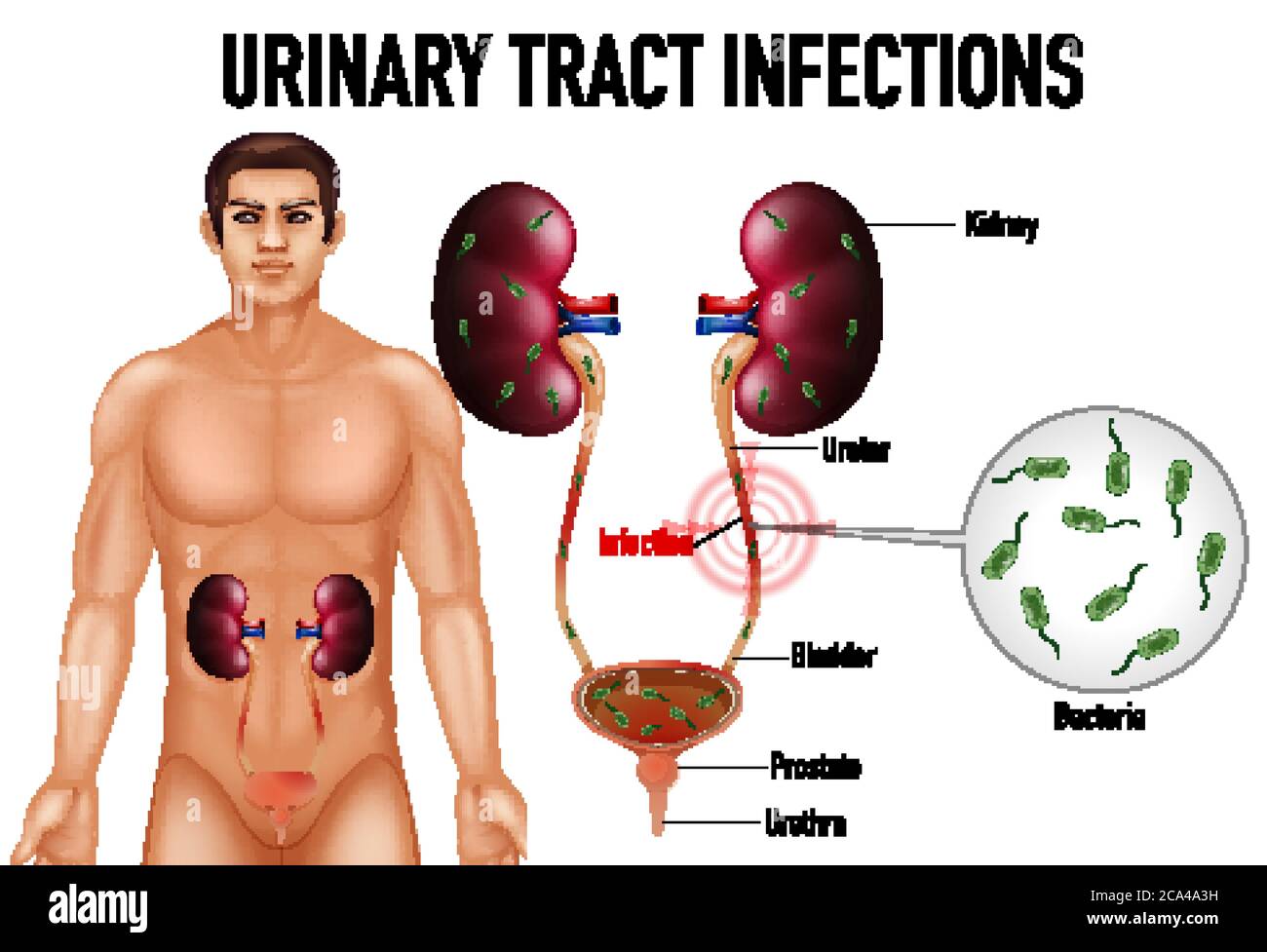 Illustration informative des infections des voies urinaires Illustration de Vecteur