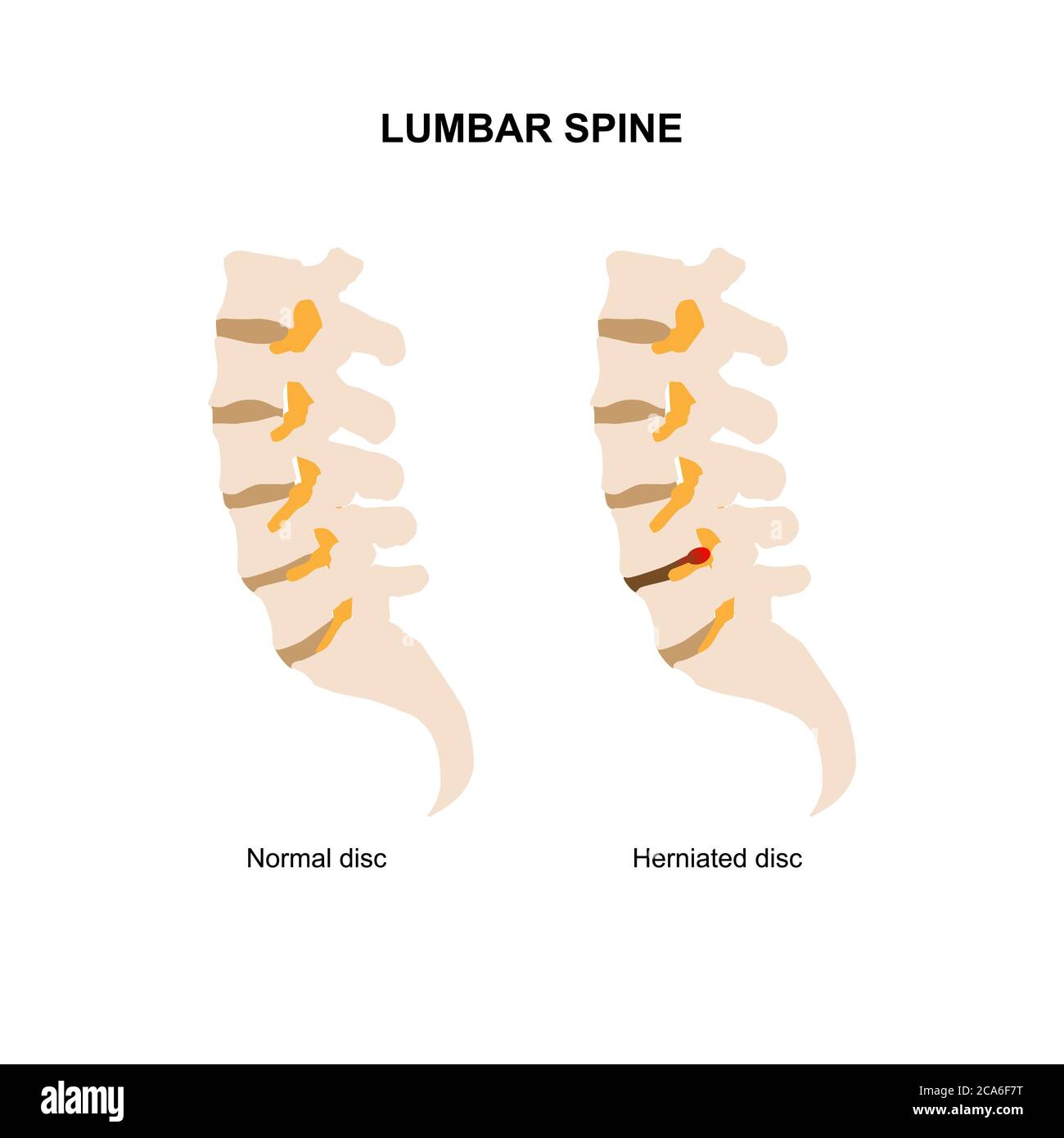 Illustration vectorielle de la colonne lombaire humaine montrant un disque lombaire normal et hernié. Illustration de Vecteur