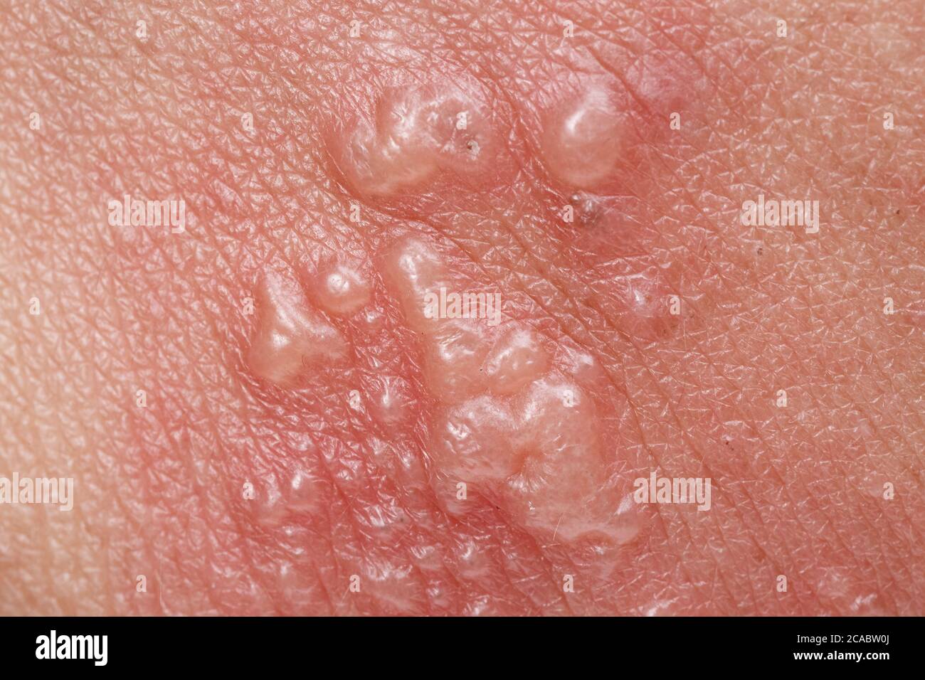 Zona, Zoster ou herpès symptômes de Zoster sur le bras Banque D'Images