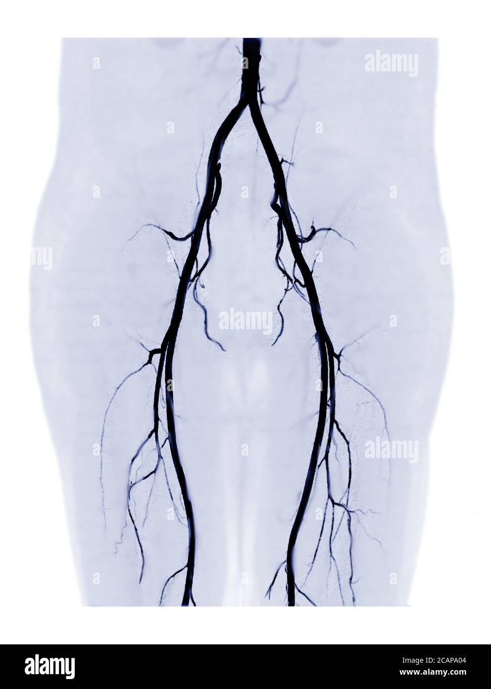 L'artère fémorale CTA affiche une image MIP 3D de l'artère fémorale pour le diagnostic de la maladie artérielle périphérique aiguë ou chronique et de la lésion de l'artère fémorale. Banque D'Images