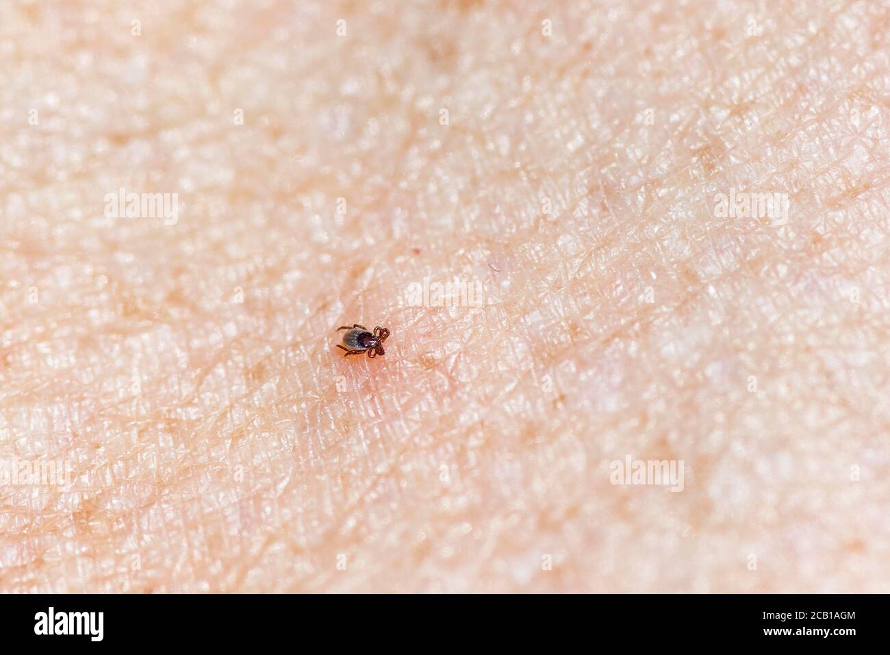 Tick de haricot de ricin (Ixodes ricinus), tique sur la peau humaine Banque D'Images