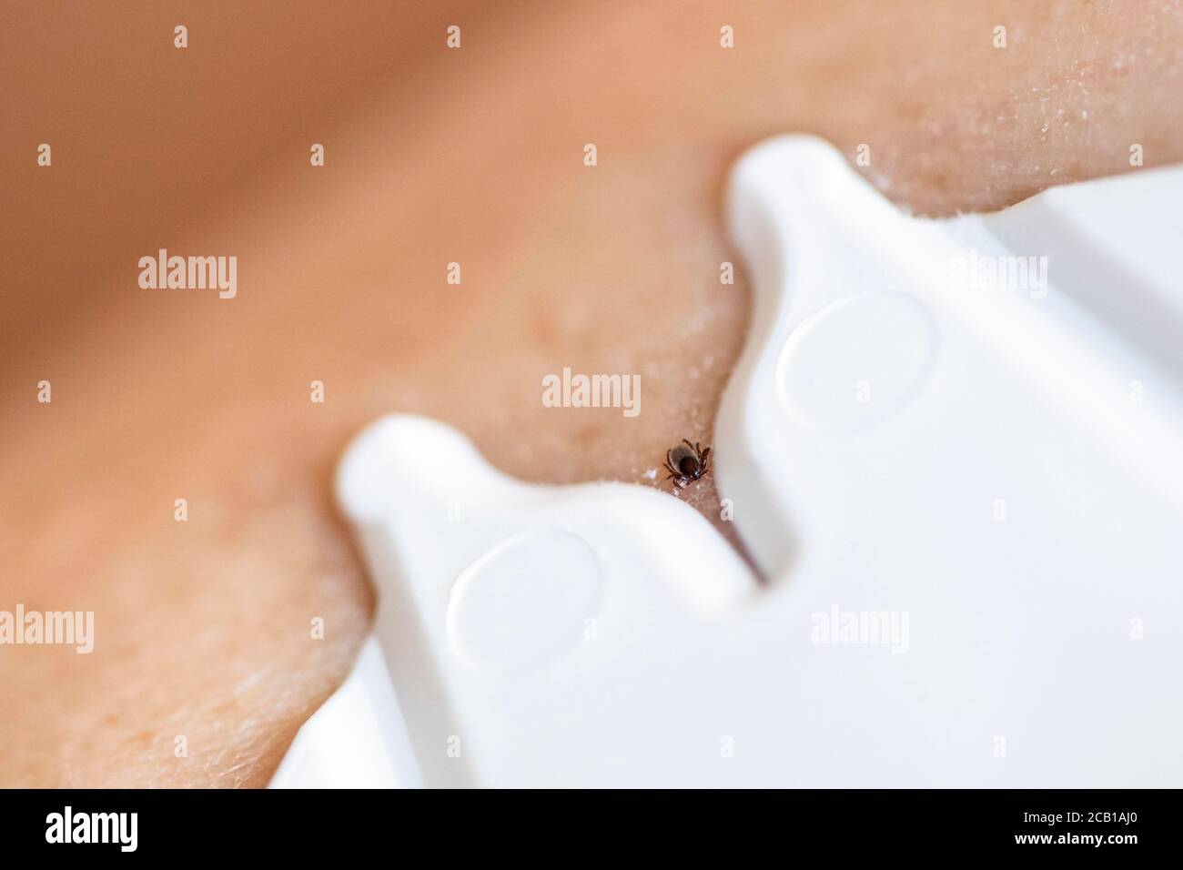 Ricin haricot Tick (Ixodes ricinus), tique sur la peau humaine, retrait par carte à tiques Banque D'Images