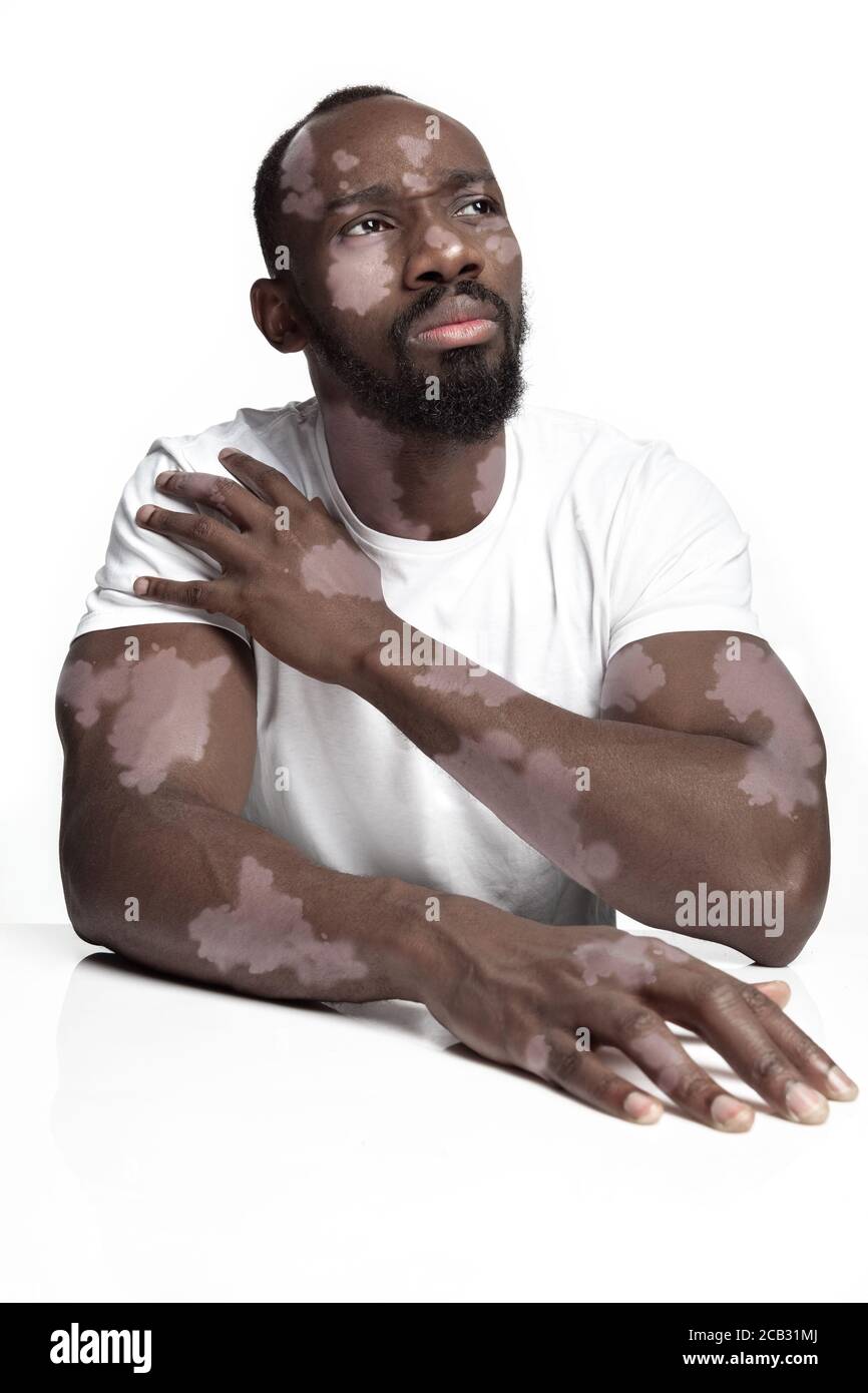 Portrait de l'homme afro-américain avec peau de vitiligo. Peau spéciale avec dépigmentation en raison de la perte de mélanine. Concept de soins de la peau et de soins de santé, inclusion et diversité, mode et beauté. Banque D'Images