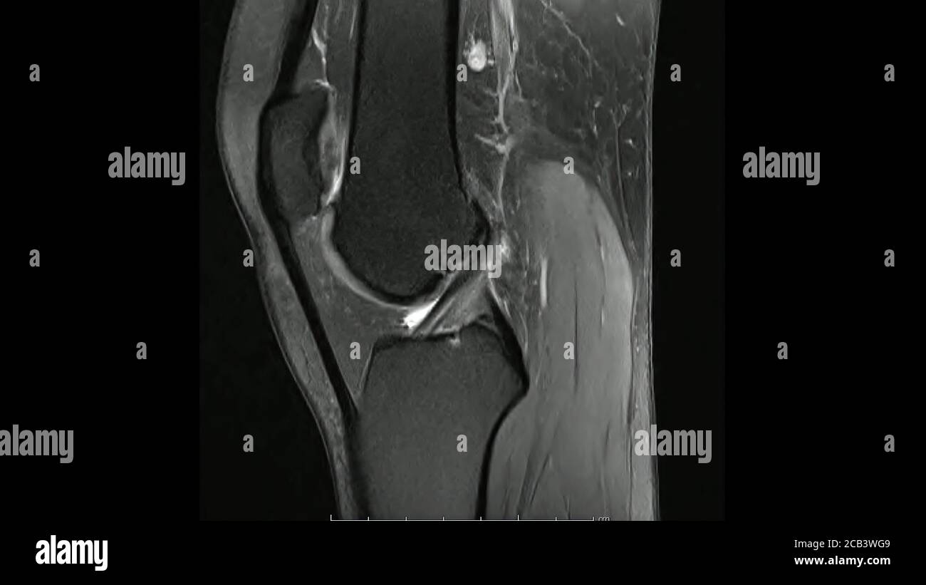 Images de résonance magnétique de la densité de protons sagittale de l'articulation du genou Images en mode ciné (articulation du genou IRM) montrant l'anatomie du genou Banque D'Images