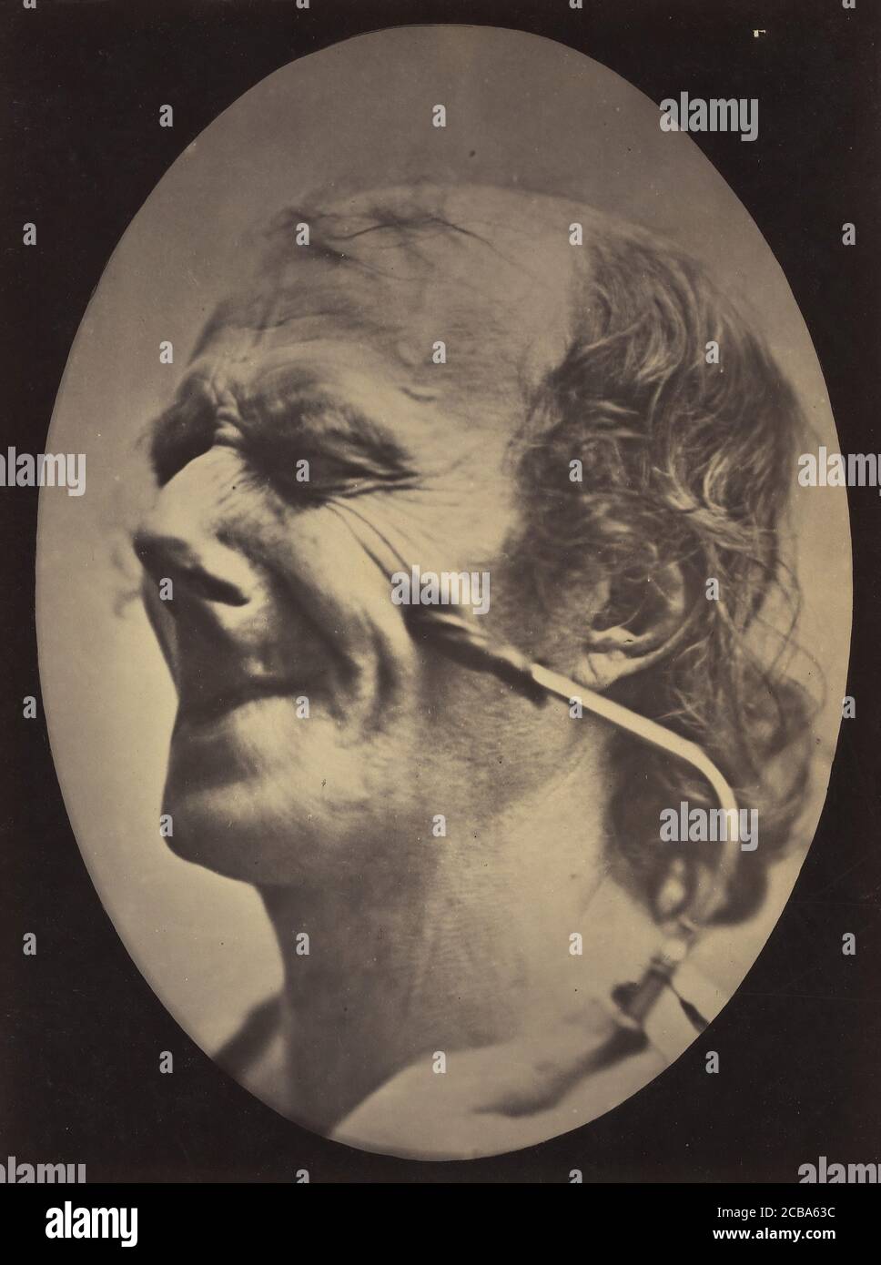 Figure 6: La grimace produite est semblable à une tique du visage , 1854-56, imprimé en 1862. Banque D'Images