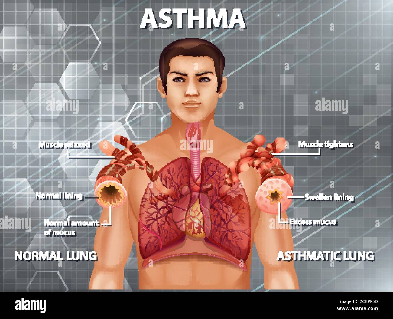 Comparaison des poumons sains et des poumons asthmatiques Illustration de Vecteur