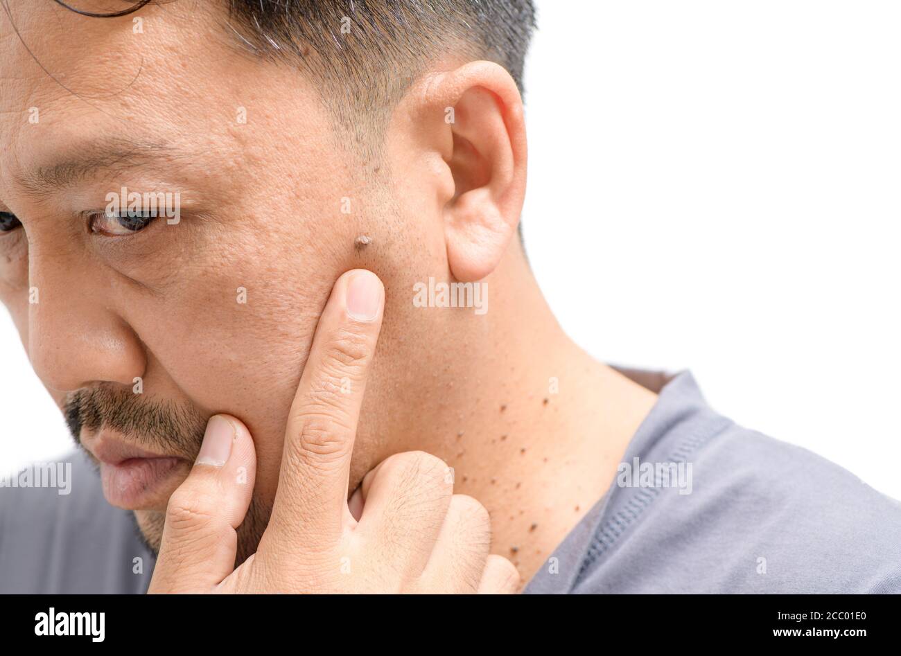 Homme asiatique d'âge moyen s'inquiète des grandes étiquettes de peau ou Acrochordon sur le visage isolé sur fond blanc, concept de soins de santé Banque D'Images