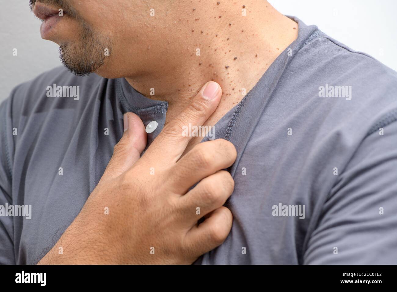 Fermé la peau Tags ou Acrochordon sur le cou homme sur fond blanc. Concept de soins de santé Banque D'Images