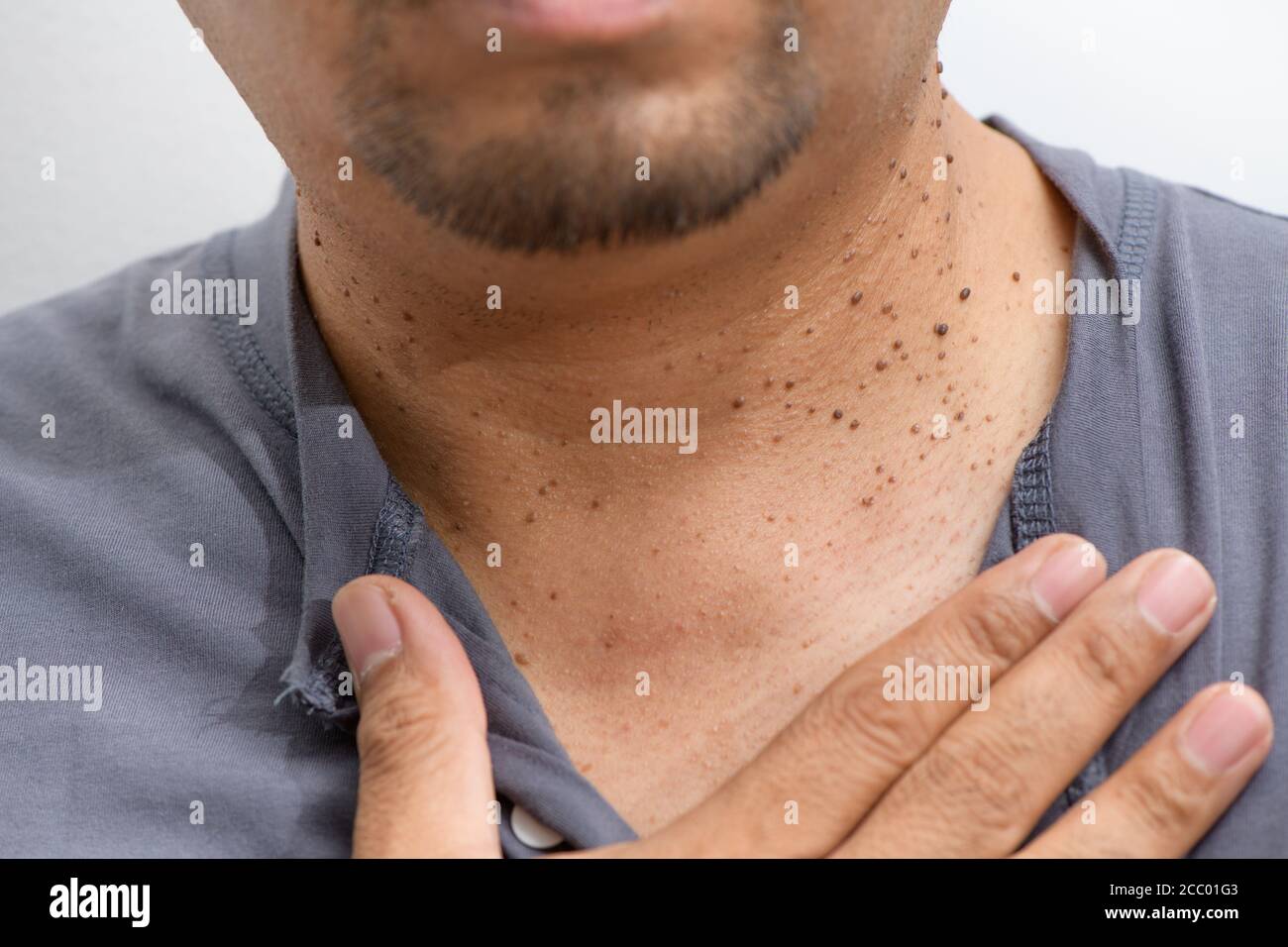 Fermé la peau Tags ou Acrochordon sur le cou homme sur fond blanc. Concept de soins de santé Banque D'Images