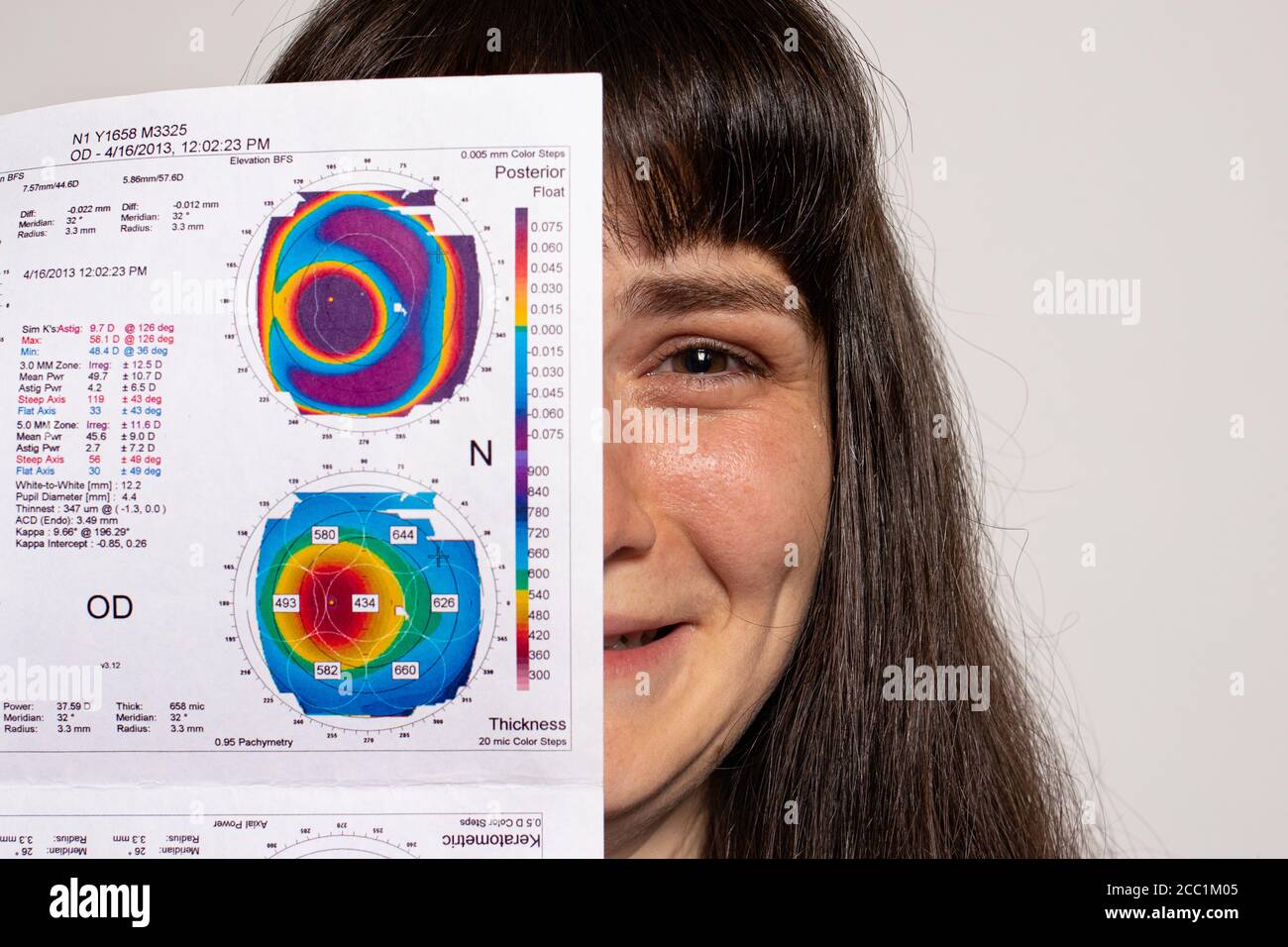 Une maladie rare des yeux. Kératométrie, dystrophie cornéenne Banque D'Images