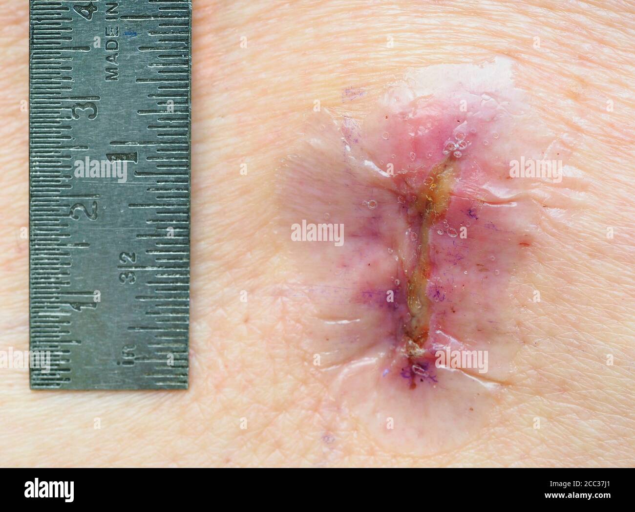 Gros plan image de l'incision d'une micro-Laminenectomie lombaire Chirurgie et une règle montrant sa taille une semaine après Chirurgie Banque D'Images
