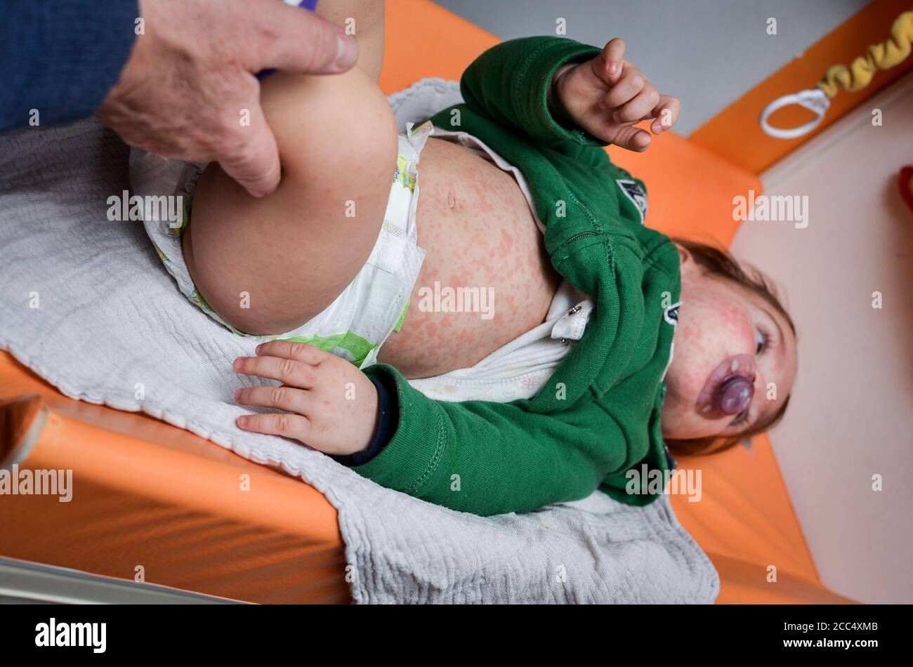 Maladies Virales Ou Allergies Chez Les Enfants Eruption De Rougeole Rouge Sur Bebe Enfant Avec Infection Virale De La Maladie D Enfants Concept De La Maladie Virale Du Bebe Et De La Vaccine