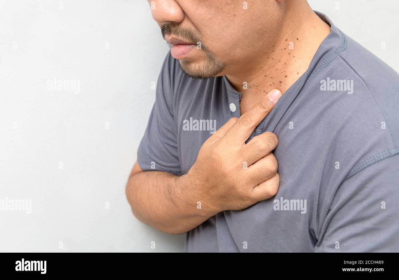 Un homme d'âge moyen pointait un doigt sur les étiquettes de la peau Ou Acrochordon sur son cou sur fond blanc.problèmes de peau de personnes âgées Banque D'Images