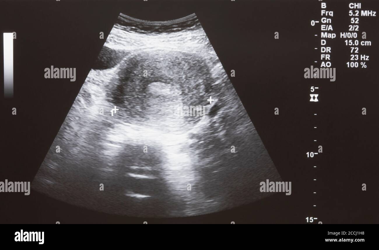 Echographie De La Tete De Bebe Banque D Image Et Photos Alamy