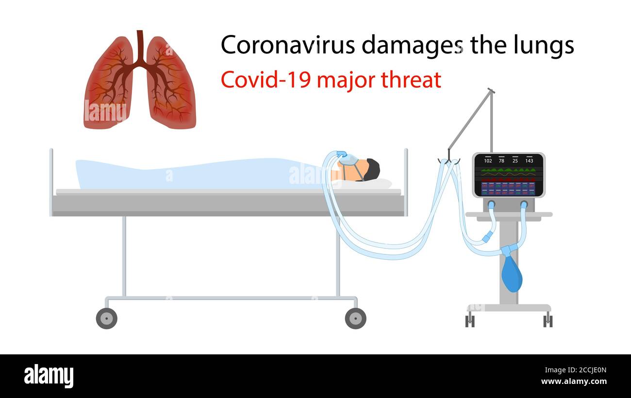 La menace majeure de dommages aux poumons du coronavirus. Un homme est au lit avec un ventilateur. Illustration des poumons avec des zones endommagées. Vecteur isolé EPS10. Illustration de Vecteur