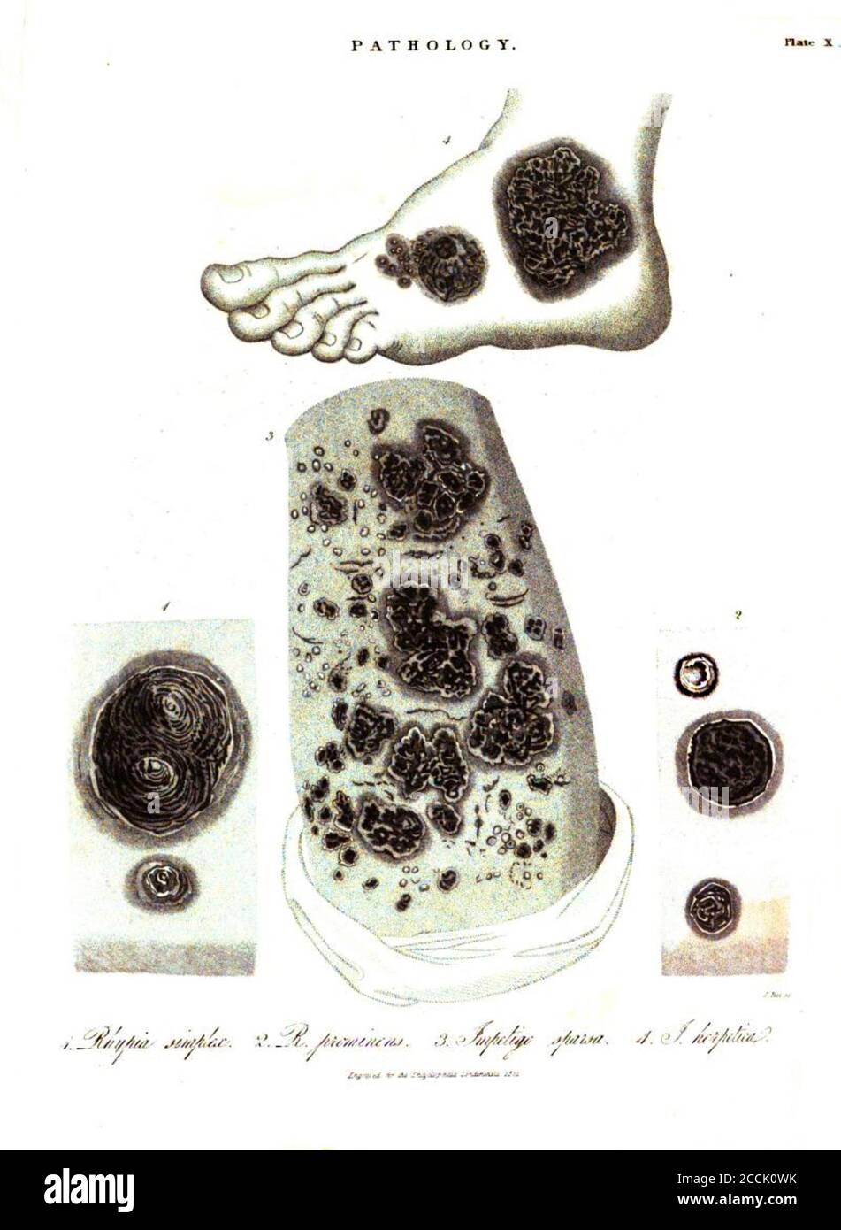 Illustration d'une maladie pathologique de la peau causée par une infection bactérienne (Impétigo) de l'Encyclopedia Londinensis or, Dictionnaire universel des arts, des sciences et de la littérature; Volume XIX; édité par Wilkes, John. Publié à Londres en 1823 Banque D'Images