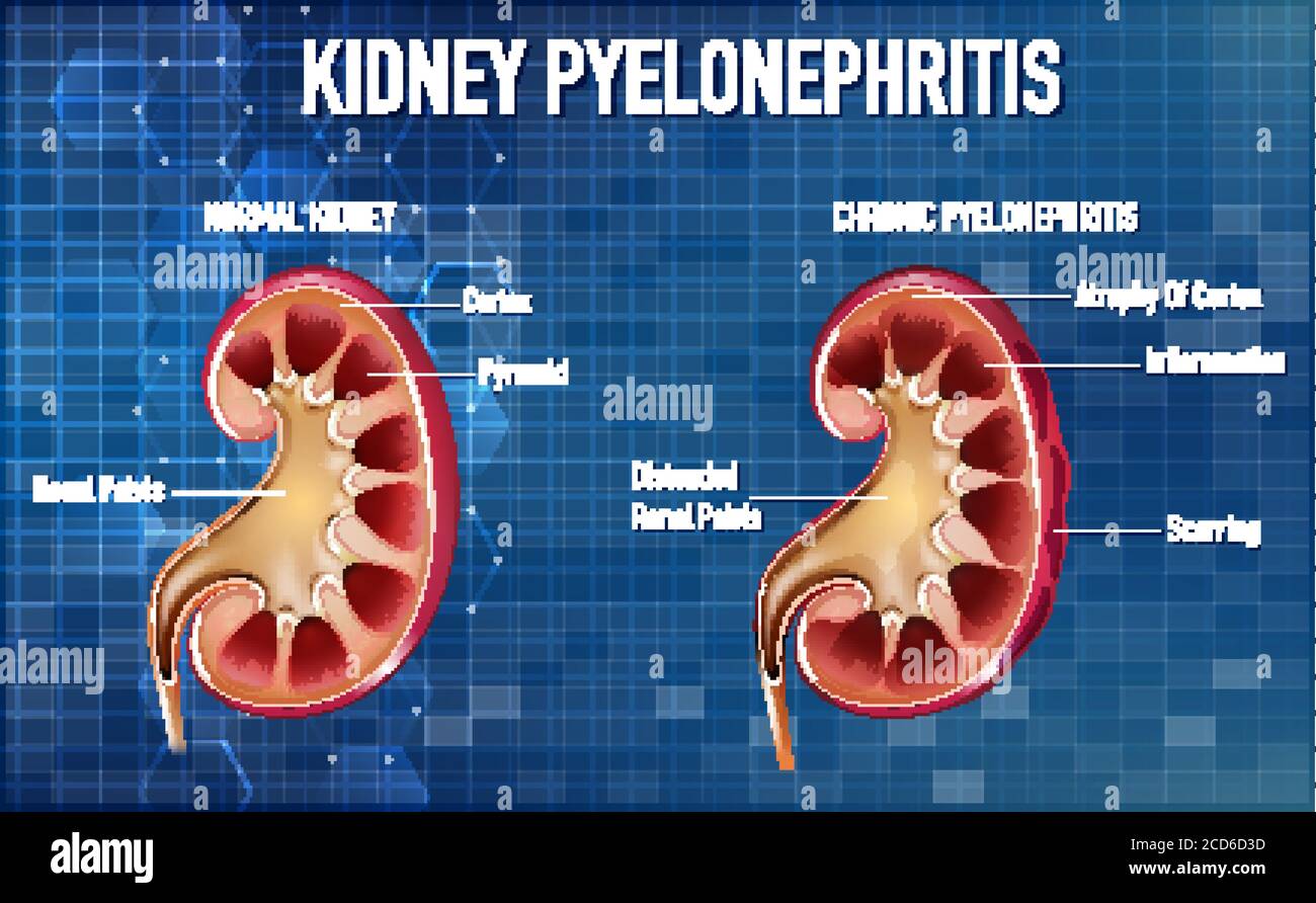 Illustration informative de la pyélonéphrite Illustration de Vecteur