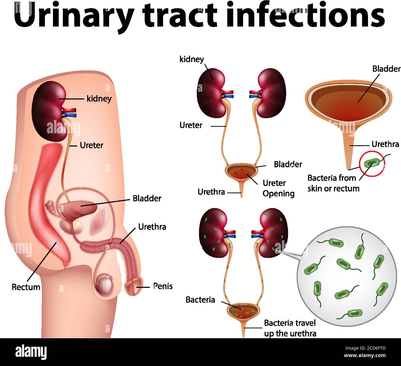 Illustration informative des infections des voies urinaires Illustration de Vecteur