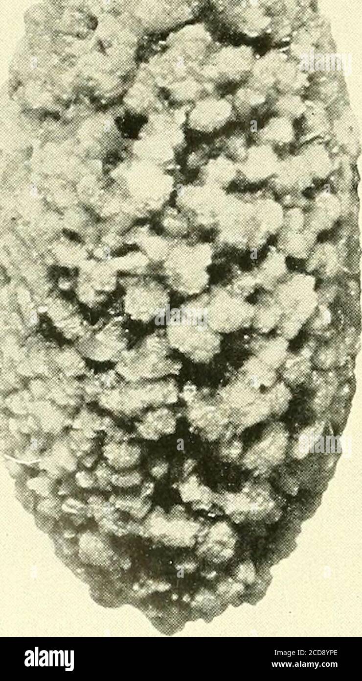 . La chirurgie, ses principes et la pratique . trix aboutlequel se forme le concrétion. Ce point de vue a été remis en question.les pierres dans le rein sont primaires ou secondaires. Le premier consistant d'acide urique, urate de sodium et d'ammonium, oxalate de chaux, carbonatede chaux, et enfin de cystine ou de xanthine. Ils sont déposés de la théurine sans aucun changement de nature infectieuse. Le calcul secondaire, qui consiste pour la plupart de phosphate de chaux, ne se développe que dans un enfant déjà le siège de l'infection. Par conséquent, un calcul primaire est souvent incrusté de phosphate de chaux. Secondar Banque D'Images